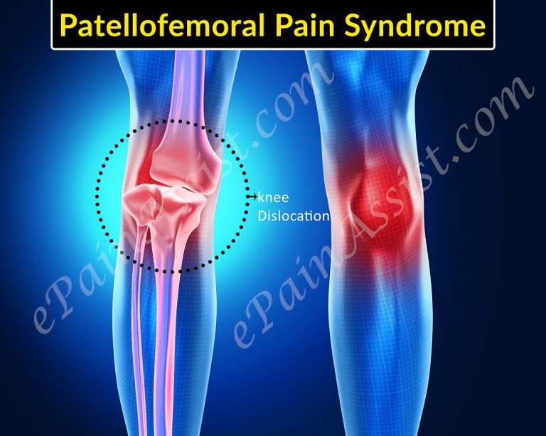 Patellofemoral Pain Syndrome Exercises and Physical Therapy