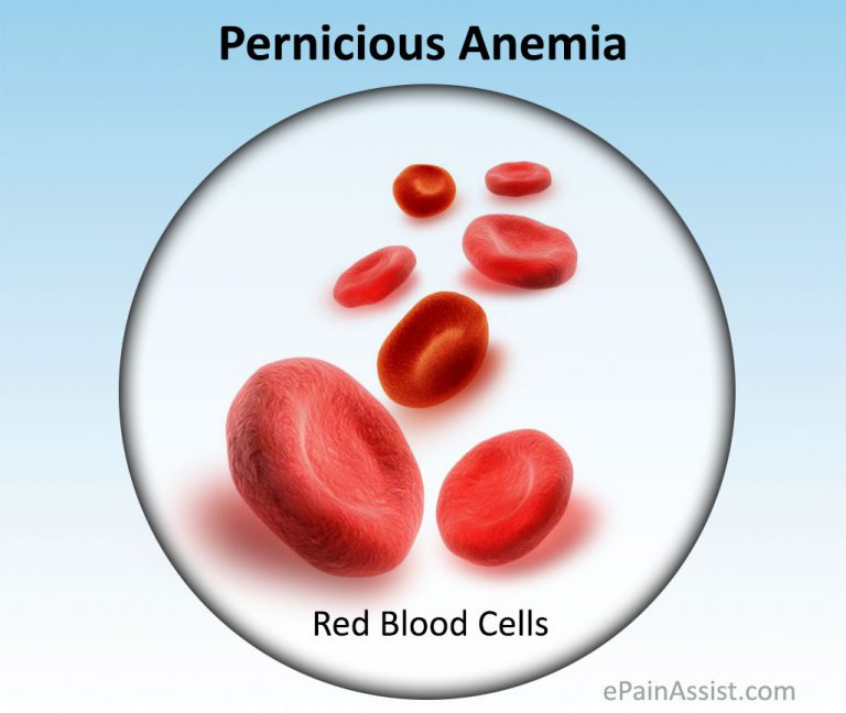 Pernicious Anemia or Addison–Biermer Anemia: Causes, Risk Factors, Symptoms, Treatment