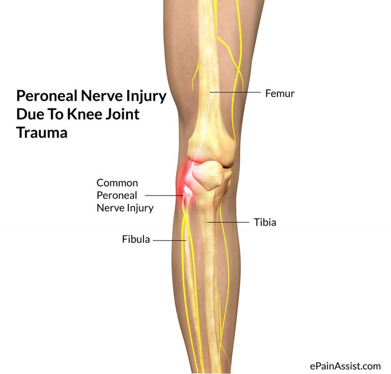 Peroneal Nerve Injury Due To Knee Joint Trauma-Causes, Symptoms, Treatment