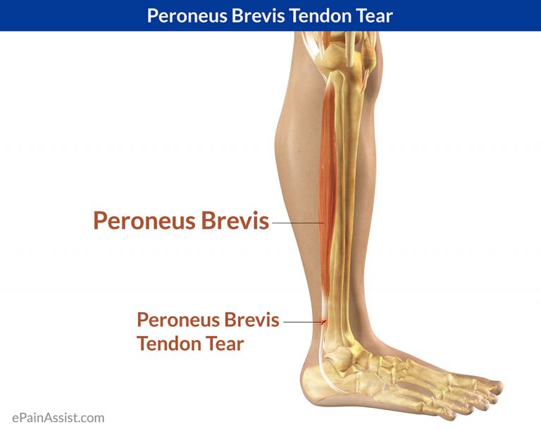 Peroneus Brevis Tendon Tear: Symptoms, Causes, Treatment, Exercises, Sports Massage