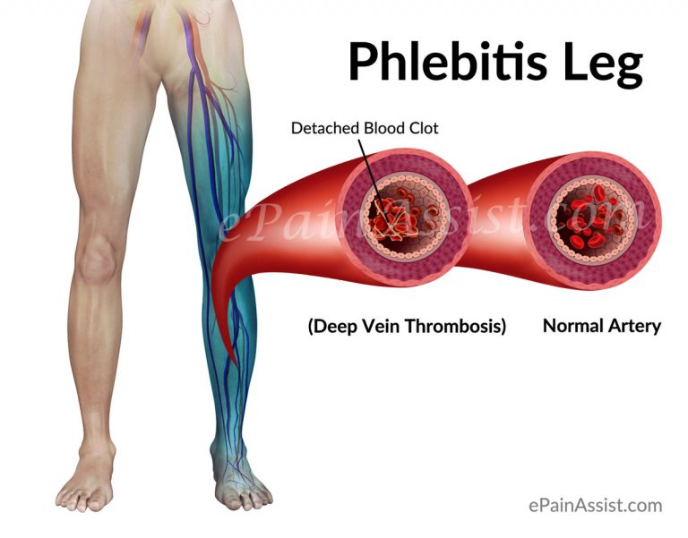 What is Phlebitis Leg and How Is It Treated?