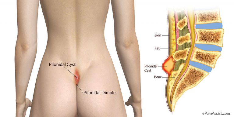 Pilonidal Cyst or Pilonidal Abscess: Causes, Risk Factors, Symptoms, Treatment, Prevention