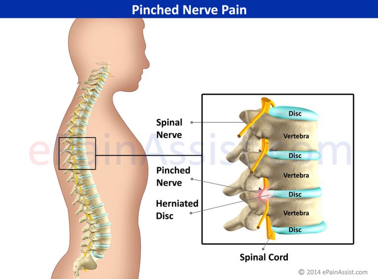 Pinched Nerve Pain: Types, Symptoms, Treatment- Conservative, Medications, Surgery