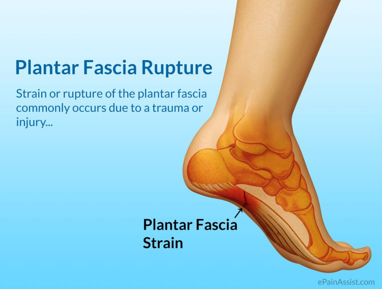Plantar Fascia Strain or Plantar Fascia Rupture: Causes, Symptoms, Treatment
