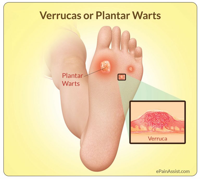Verrucas or Plantar Warts: Causes, Symptoms, Treatment- Salicylic Acid Plasters