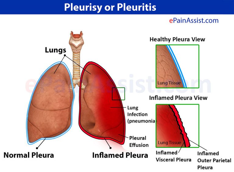 Pleuritis: Causes, Symptoms, Signs, Treatment