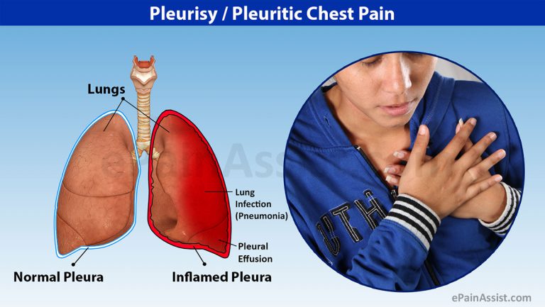 Pleuritic Chest Pain: Definition, Facts, Causes, Symptoms, Diagnosis, Treatment, Prevention