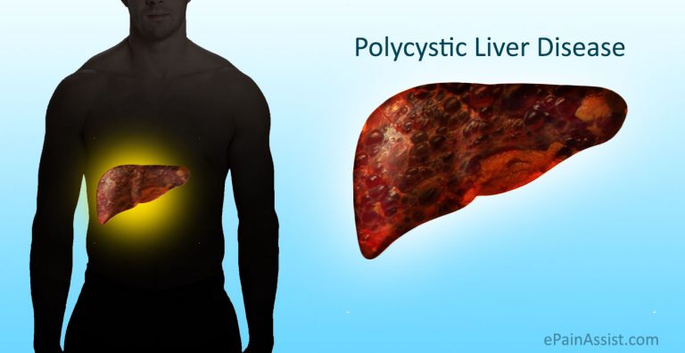 Polycystic Liver Disease (PLD): Causes, Symptoms, Signs, Diagnosis, Treatment