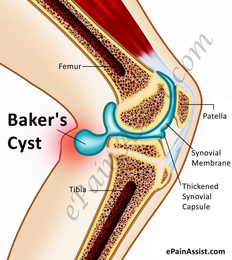 Baker’s Cyst or Popliteal Cyst: Causes,Symptoms, Treatment, Exercise, Home Treatment