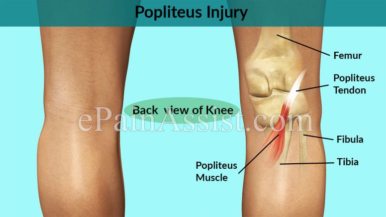 Popliteus Injury: Symptoms, Treatment- Sports Massage, NSAIDs, Knee Braces