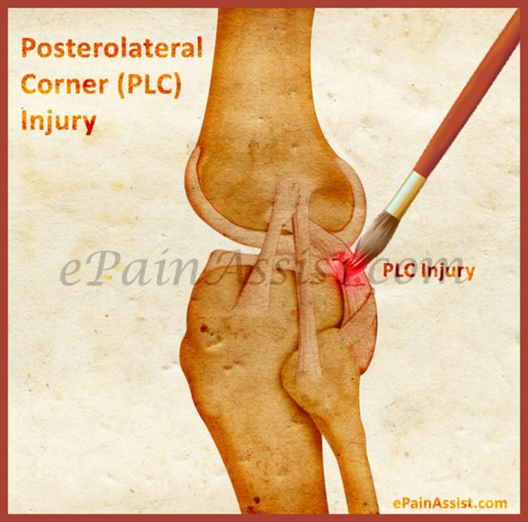 Posterolateral Corner (PLC) Injury: Signs, Symptoms, Causes, Classification, Treatment