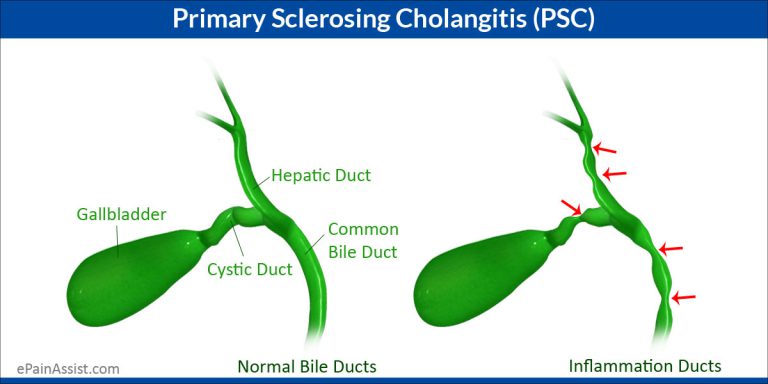Primary Sclerosing Cholangitis (PSC): Definition, Causes, Risk Factors, Symptoms, Diagnosis, Treatment, Complications, Home Remedies