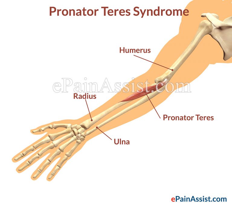 Pronator Teres Syndrome or PTS: Symptoms, Causes, Treatment-Ice, Pain Killers