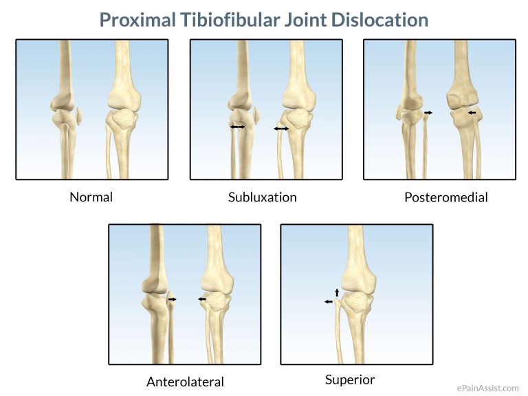 Proximal Tibiofibular Joint Dislocation: Symptoms, Causes, Treatment- Cold Therapy, Surgery