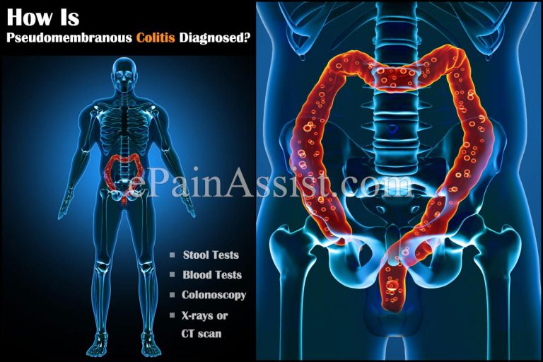 Pseudomembranous: Causes, Symptoms, Diagnosis, Treatment