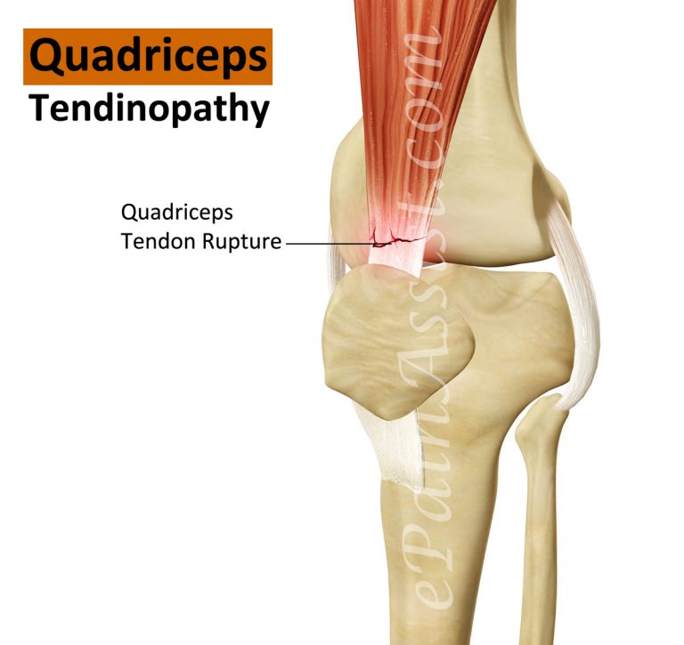 Quadriceps Tendinopathy: Signs, Symptoms, Treatment, Strengthening, Stretching Exercises