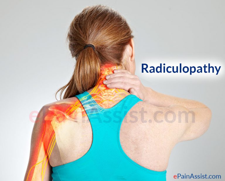 Radiculopathy or Radicular Pain: Classification, Pathophysiology, Causes