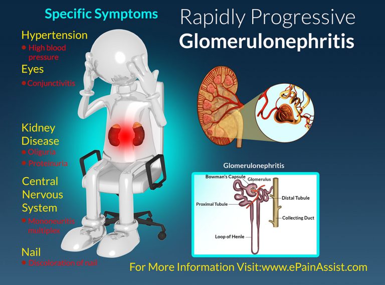 Rapidly Progressive Glomerulonephritis (RPGN): Causes, Symptoms, Treatment, Risk Factors