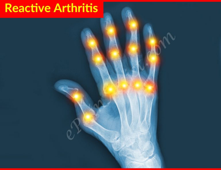 Reactive Arthritis: Causes, Risk Factors, Investigations, Treatment, Prevention