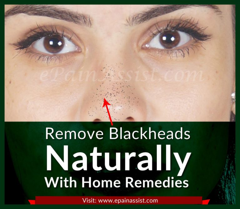 Remove Blackheads Naturally With These Home Remedies
