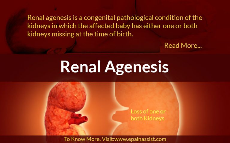 Renal Agenesis: Causes, Risk Factors, Symptoms, Treatment, Prevention, Types, Diagnosis