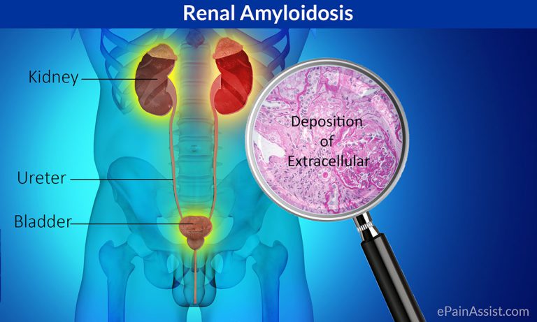 Renal Amyloidosis: Causes, Risk Factors, Classification, Symptoms, Diagnosis, Treatment