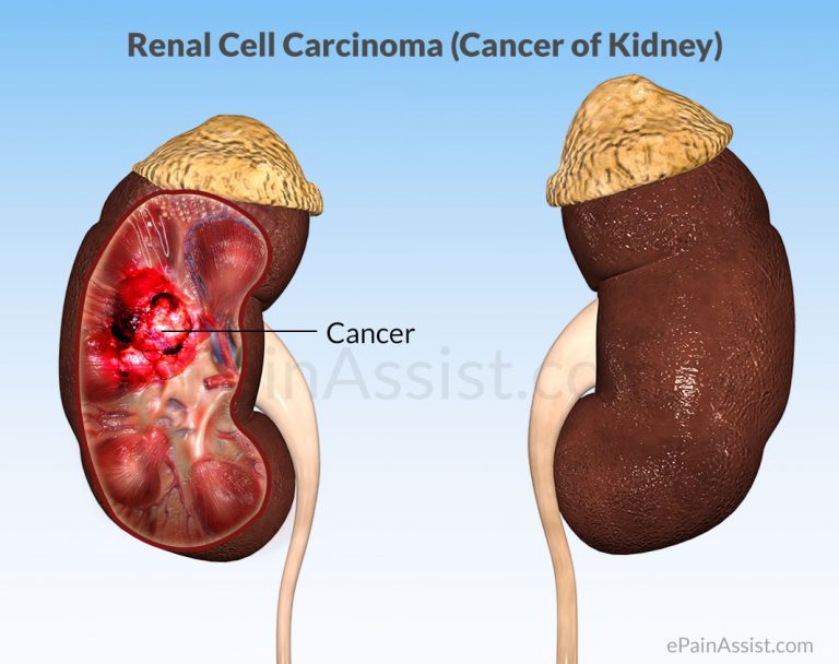 Renal Cell Carcinoma (Cancer of Kidney): Causes, Risk Factors, Symptoms, Stages, Treatment