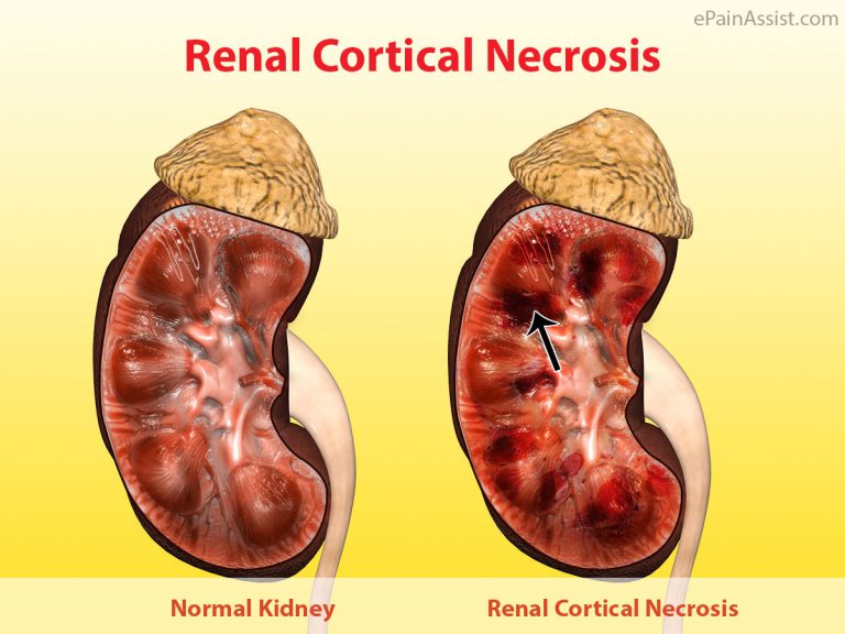 Renal Cortical Necrosis (RCN): Types, Causes, Risk Factors, Symptoms, Diagnosis, Treatment