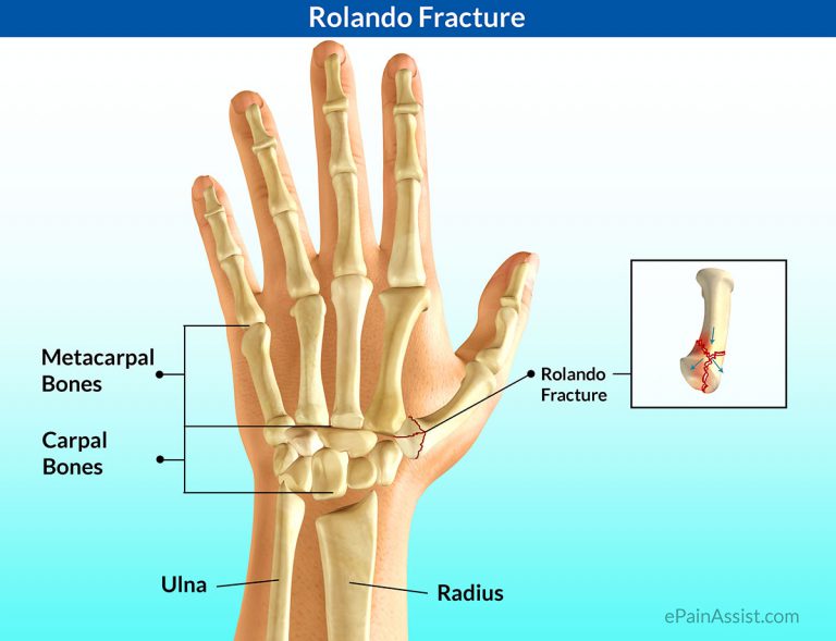 Rolando Fracture: Causes, Signs, Symptoms, Treatment, Exercises, Investigations