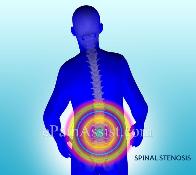 Lumbar Spinal Stenosis: Causes, Symptoms, Signs, Treatment-Pain Therapy, PT, Surgery