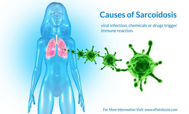 Sarcoidosis or Sarcoid : Definition, Causes, Risk Factors, Symptoms, Signs, Diagnosis, Treatment
