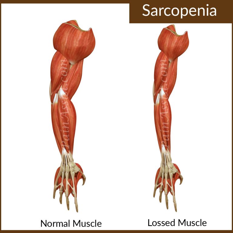What Is Sarcopenia And How Can It Be Prevented ?