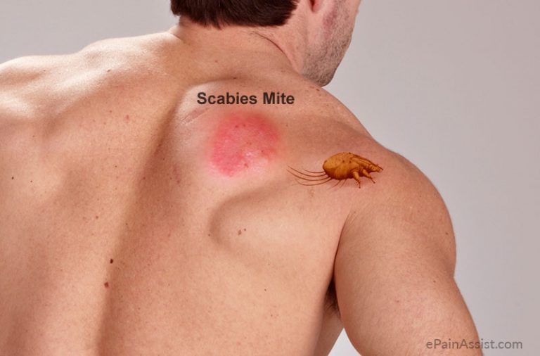 Scabies: Causes, Signs, Symptoms, Investigations, Treatment, Home Remedies, Prevention