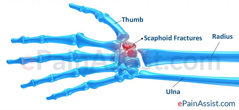Scaphoid Fracture