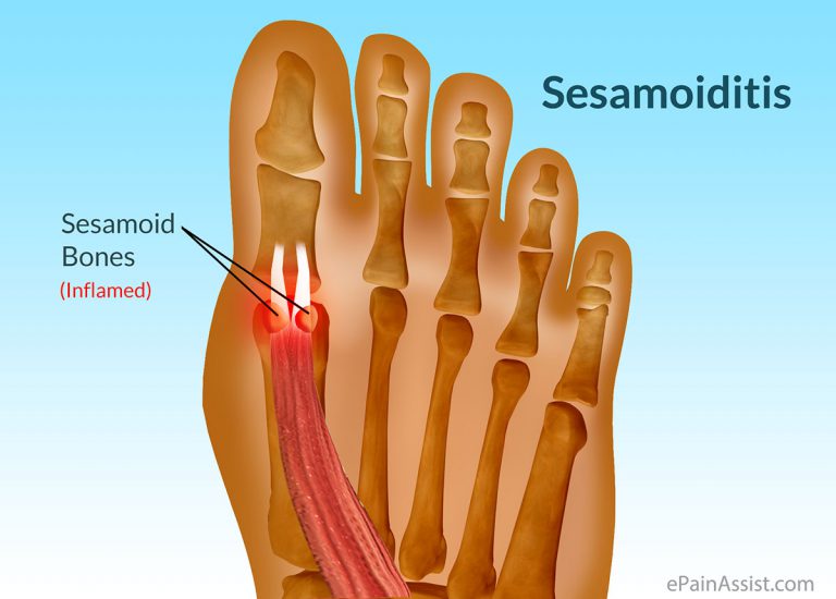 Sesamoiditis: Symptoms, Causes, Treatment- Anti-inflammatory Medications, Orthotics, Insoles