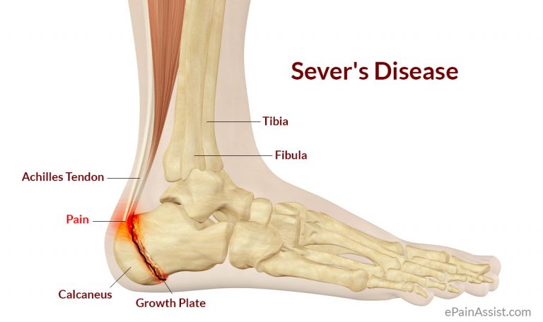 Sever’s Disease or Calcaneal Apophysitis: Signs, Symptoms, Causes, Treatment, Prevention