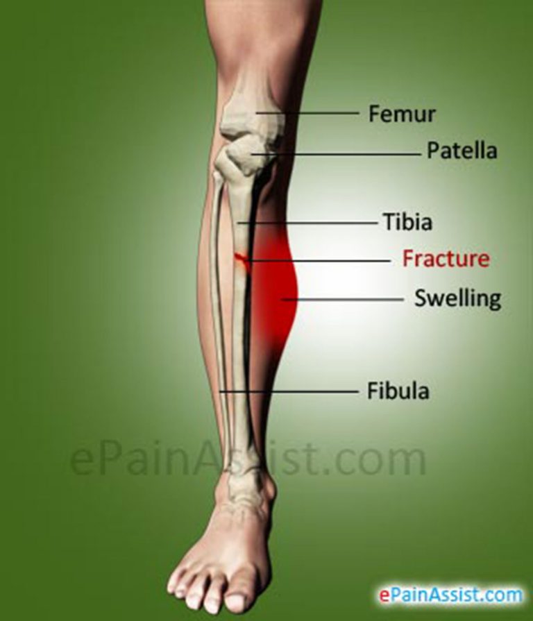 Shin Fracture or Fracture of Tibia: Causes, Symptoms, Types, Treatment