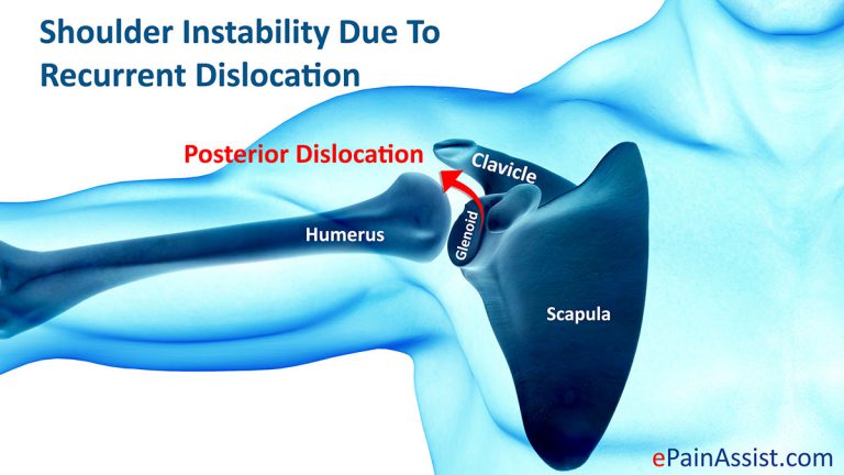 Shoulder Instability: Causes, Symptoms, Diagnosis, Treatment, Recovery & Exercise