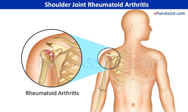 Shoulder Joint Rheumatoid Arthritis : Symptoms, Treatment- Conservative, PT, Surgery