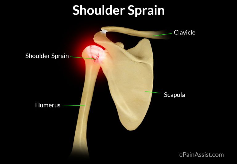 Shoulder Sprain: Classification & Types, Symptoms, Diagnosis, Treatment, Exercise