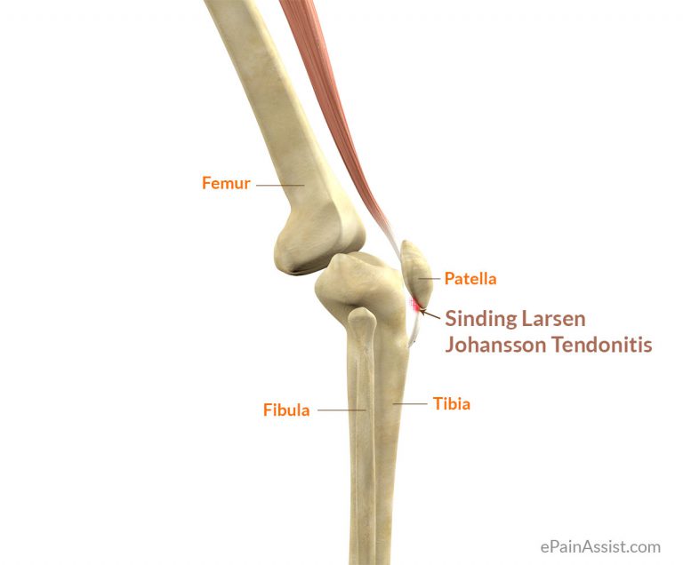 Sinding Larsen Johansson (SLJ) Syndrome: Signs, Symptoms, Treatment- Sports Massage