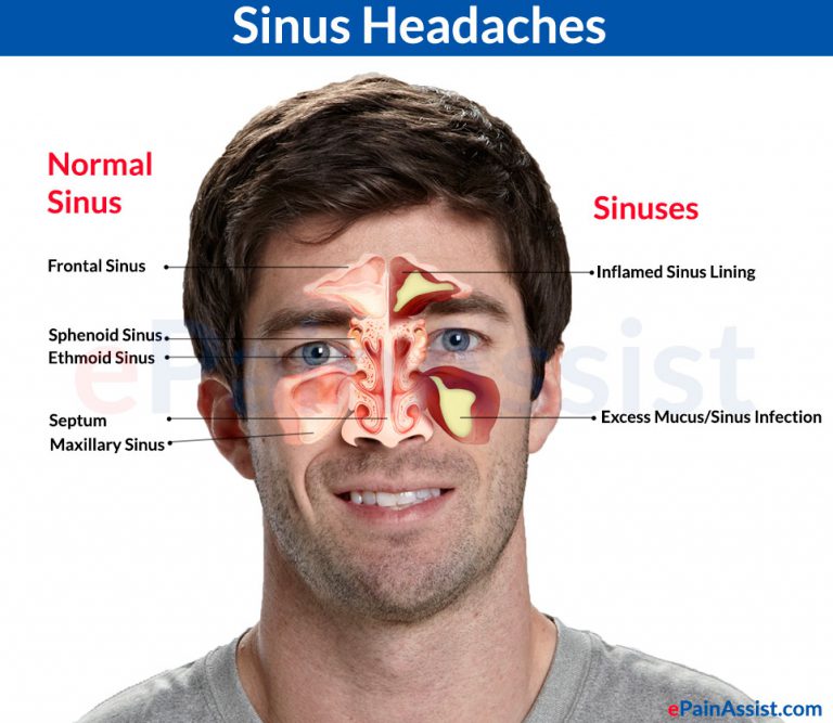 Sinus Headaches: Causes, Symptoms,Treatment, Prevention, Differentiating it from Migraine, Risk Factors, Investigations