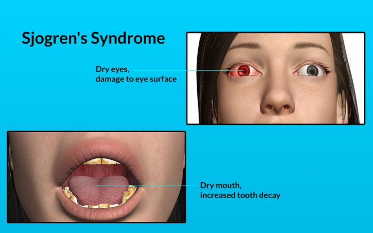 Sjogren’s Syndrome: Causes, Risk Factors, Signs, Symptoms, Investigations, Treatment