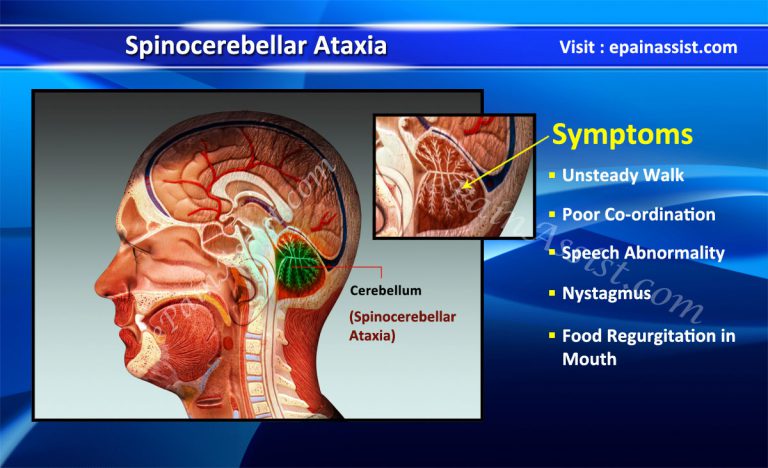 Spinocerebellar Ataxia: Causes, Symptoms, Diagnosis, Treatment, Life Expectancy