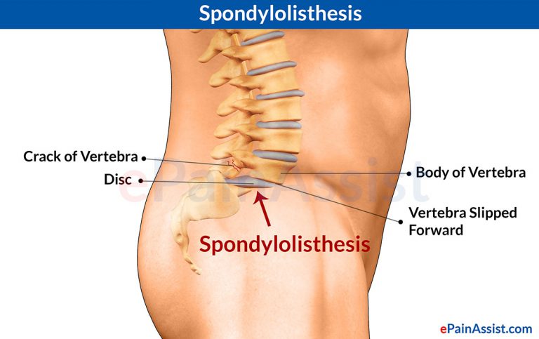 Spondylolisthesis: Know the Causes, Symptoms, Treatment, Returning to Sports