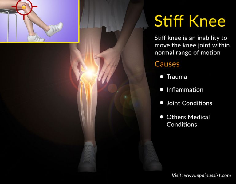 Stiff Knee: Causes, Best Exercises, Recovery Period