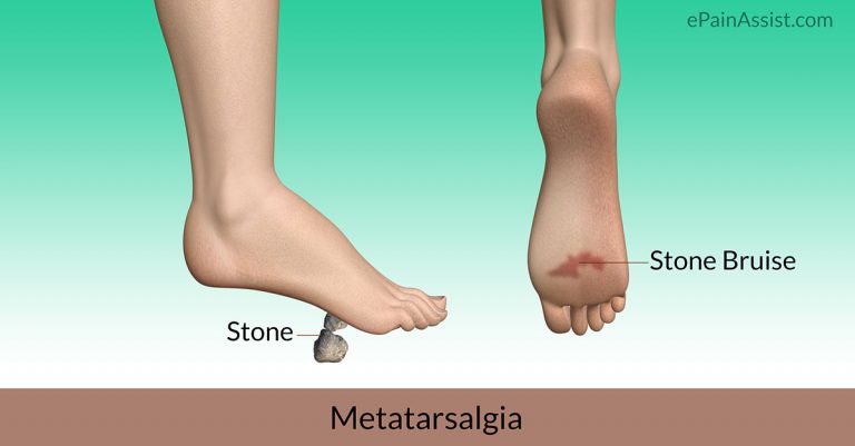 Stone Bruise or Metatarsalgia: Symptoms, Causes, Treatment