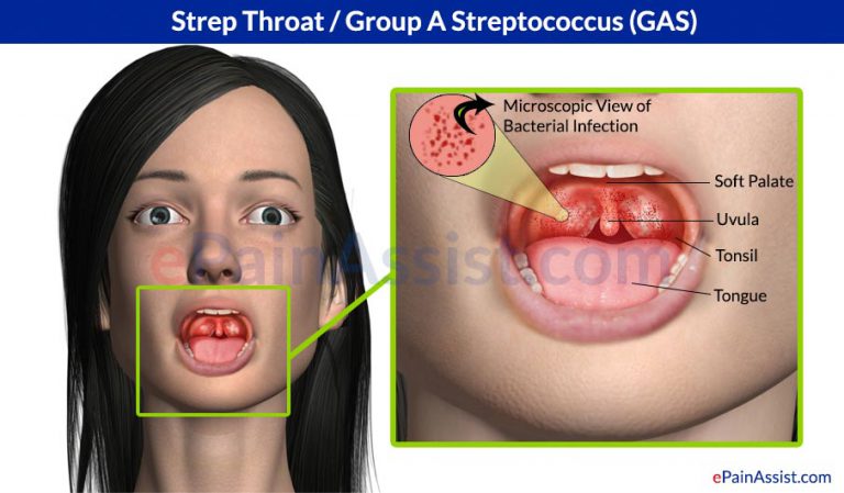 Strep Throat or Group A Streptococcus (GAS): Causes, Symptoms, Treatment, Remedies