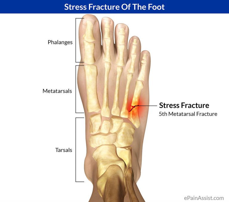 Stress Fracture of the Foot: Causes, Symptoms, Treatment
