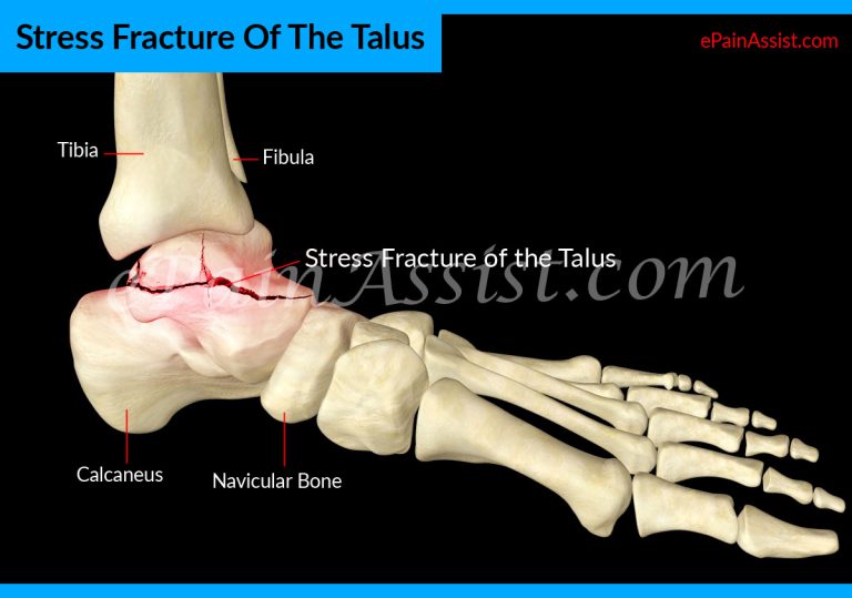 Stress Fracture Of The Talus: Causes, Symptoms, Treatment- Surgery, Rehab